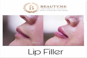 Filler Bibir Sexy / Lip Filler